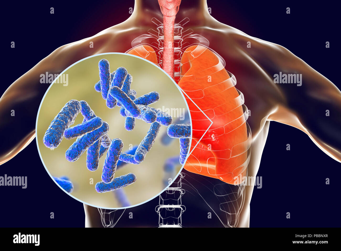 Bacterial pneumonia, conceptual illustration. Human lungs and close-up view of bacteria, one of the causative agents of pneumonia. Stock Photo