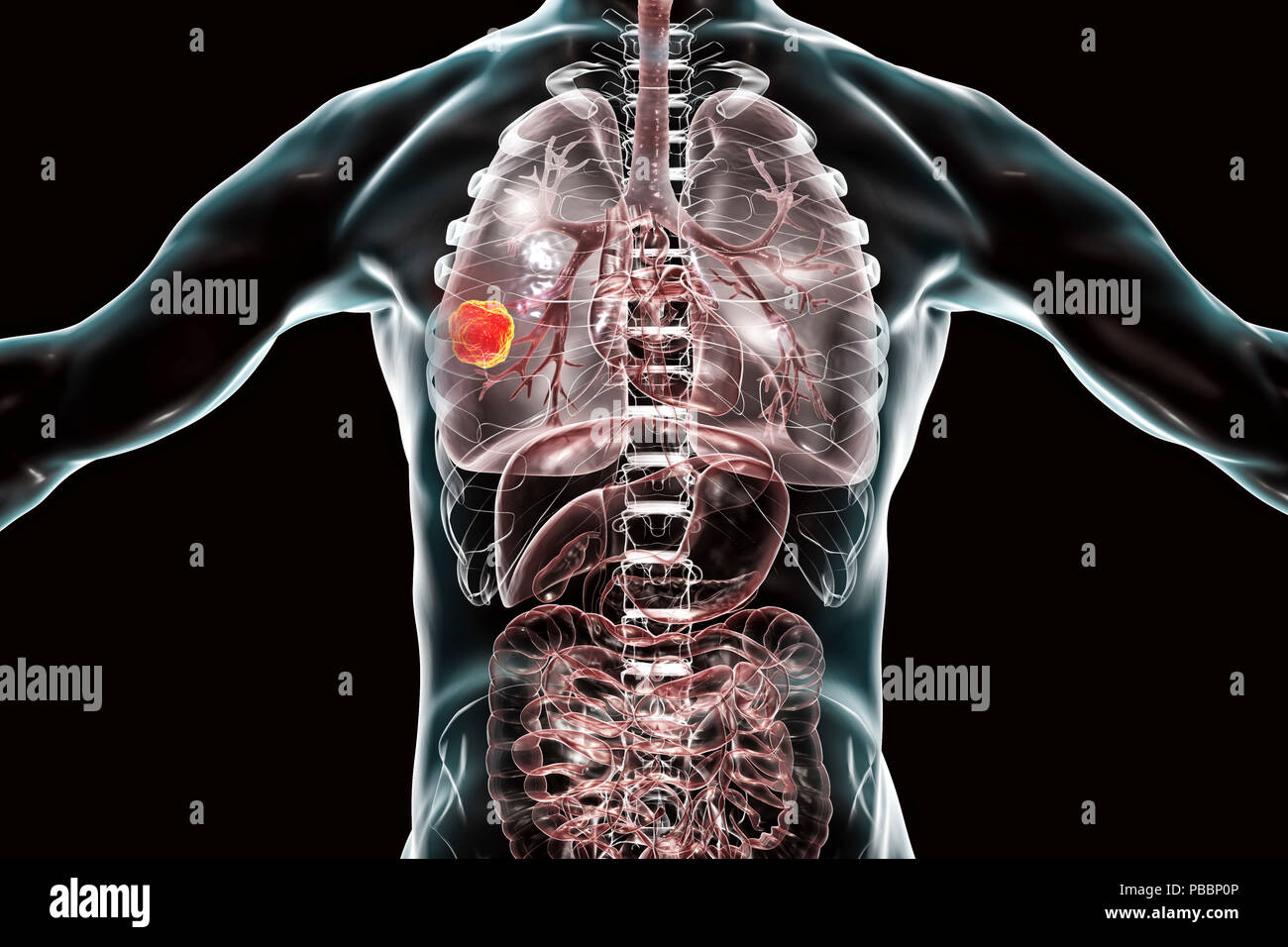 Lung cancer, computer illustration Stock Photo - Alamy