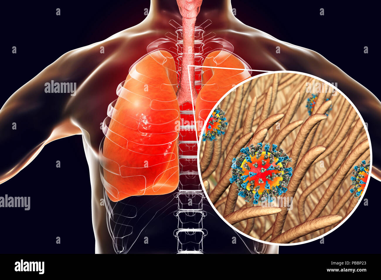 Pneumonia caused by measles viruses, conceptual computer illustration. Measles virus, from the Morbillivirus group of viruses, consists of an RNA (ribonucleic acid) core surrounded by an envelope studded with surface proteins haemagglutinin-neuraminidase and fusion protein, which are used to attach to and penetrate a host cell. Measles is a highly infectious itchy rash with a fever. It mainly affects children, but one attack usually gives life-long immunity. Pneumonia is one of common complications of measles. Stock Photo