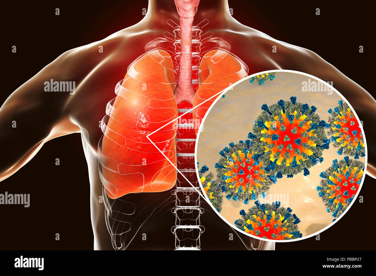 Pneumonia caused by measles viruses, conceptual computer illustration. Measles virus, from the Morbillivirus group of viruses, consists of an RNA (ribonucleic acid) core surrounded by an envelope studded with surface proteins haemagglutinin-neuraminidase and fusion protein, which are used to attach to and penetrate a host cell. Measles is a highly infectious itchy rash with a fever. It mainly affects children, but one attack usually gives life-long immunity. Pneumonia is one of common complications of measles. Stock Photo