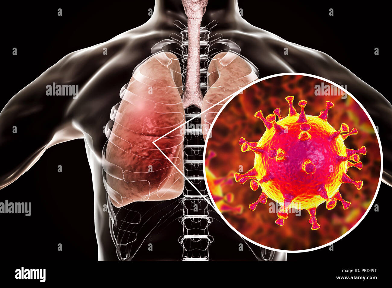 MERS virus infection of lungs, conceptual illustration. MERS (Middle East respiratory syndrome) is a viral respiratory illness caused by the MERS-associated coronavirus (MERS-CoV). Formerly known as novel coronavirus, MERS was first identified in Saudi Arabia in 2012. Most people infected with MERS develop severe acute respiratory illness with symptoms of fever, cough, and shortness of breath. Stock Photo