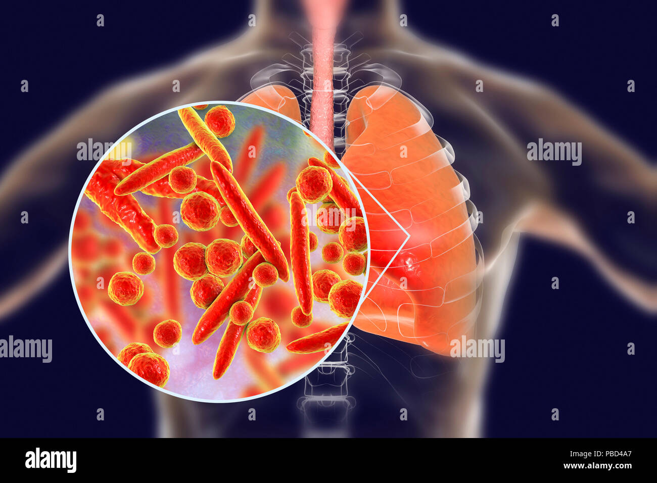 Pneumonia caused by Mycoplasma pneumoniae bacteria, conceptual computer illustration. Stock Photo