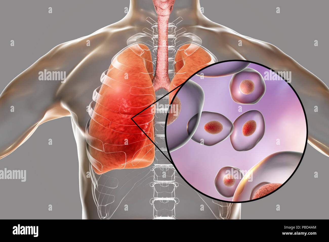 pneumocystis-pneumonia-conceptual-computer-illustration-this-lung