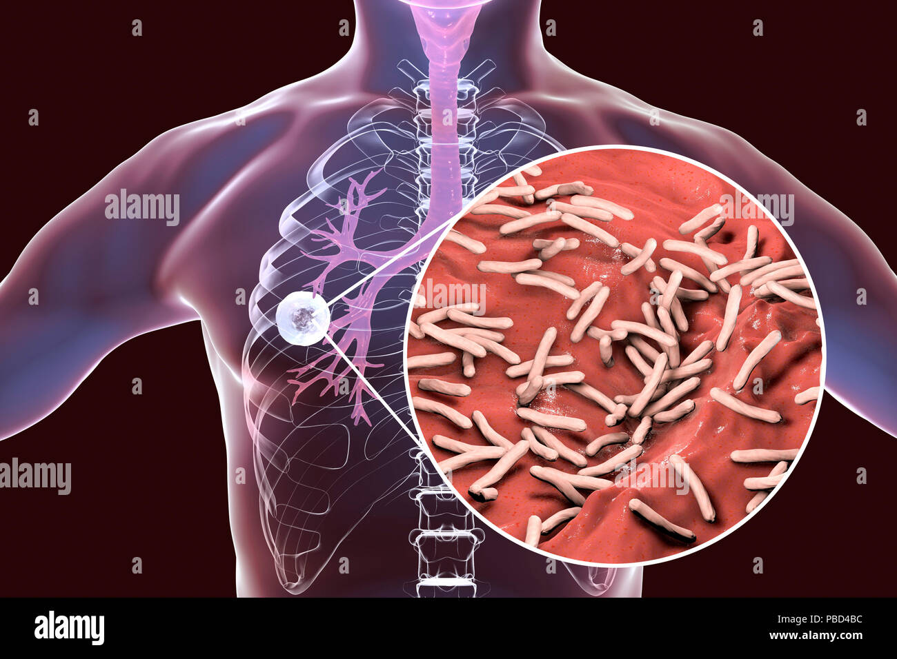 Fibrous-cavernous pulmonary tuberculosis and close-up view of Mycobacterium tuberculosis bacteria, the causative agent of tuberculosis. Computer illustration showing cavern (cavity) in the right lung with a well-formed fibrous layer in its wall. Stock Photo