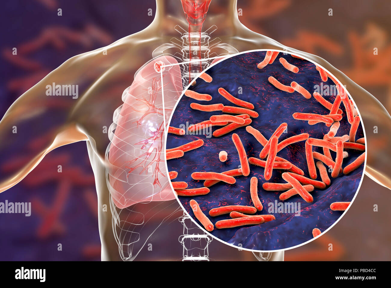 Secondary tuberculosis infection and close-up view of Mycobacterium tuberculosis bacteria, the causative agent of tuberculosis. Computer illustration showing small-sized solid nodular mass located in the upper lobe of right lung near lung apex. Stock Photo