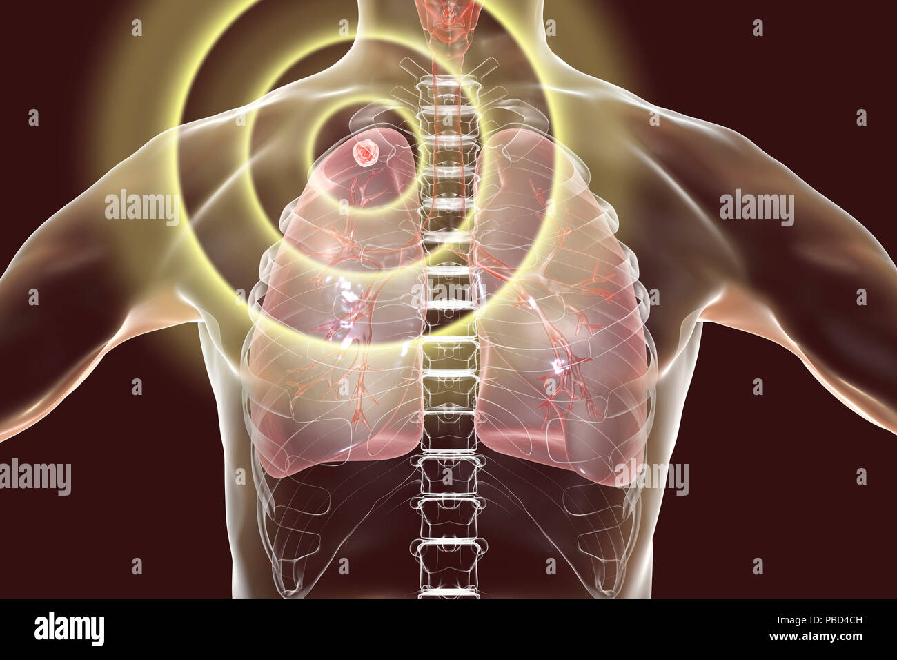 Treatment and prevention of tuberculosis, conceptual illustration. Stock Photo