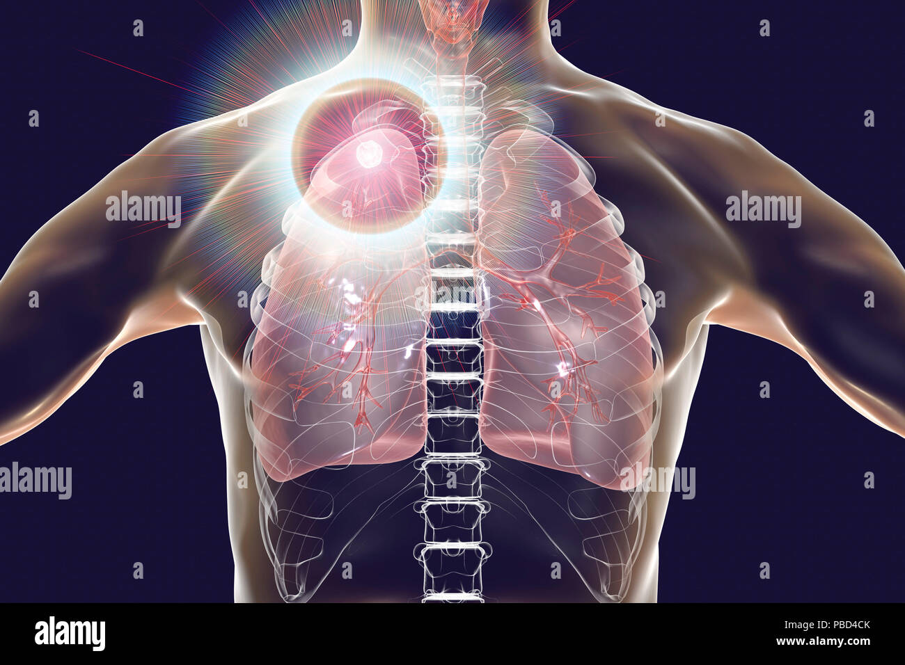 Secondary tuberculosis infection and close-up view of Mycobacterium tuberculosis bacteria, the causative agent of tuberculosis. Computer illustration showing small-sized solid nodular mass located in the upper lobe of right lung near lung apex. Stock Photo