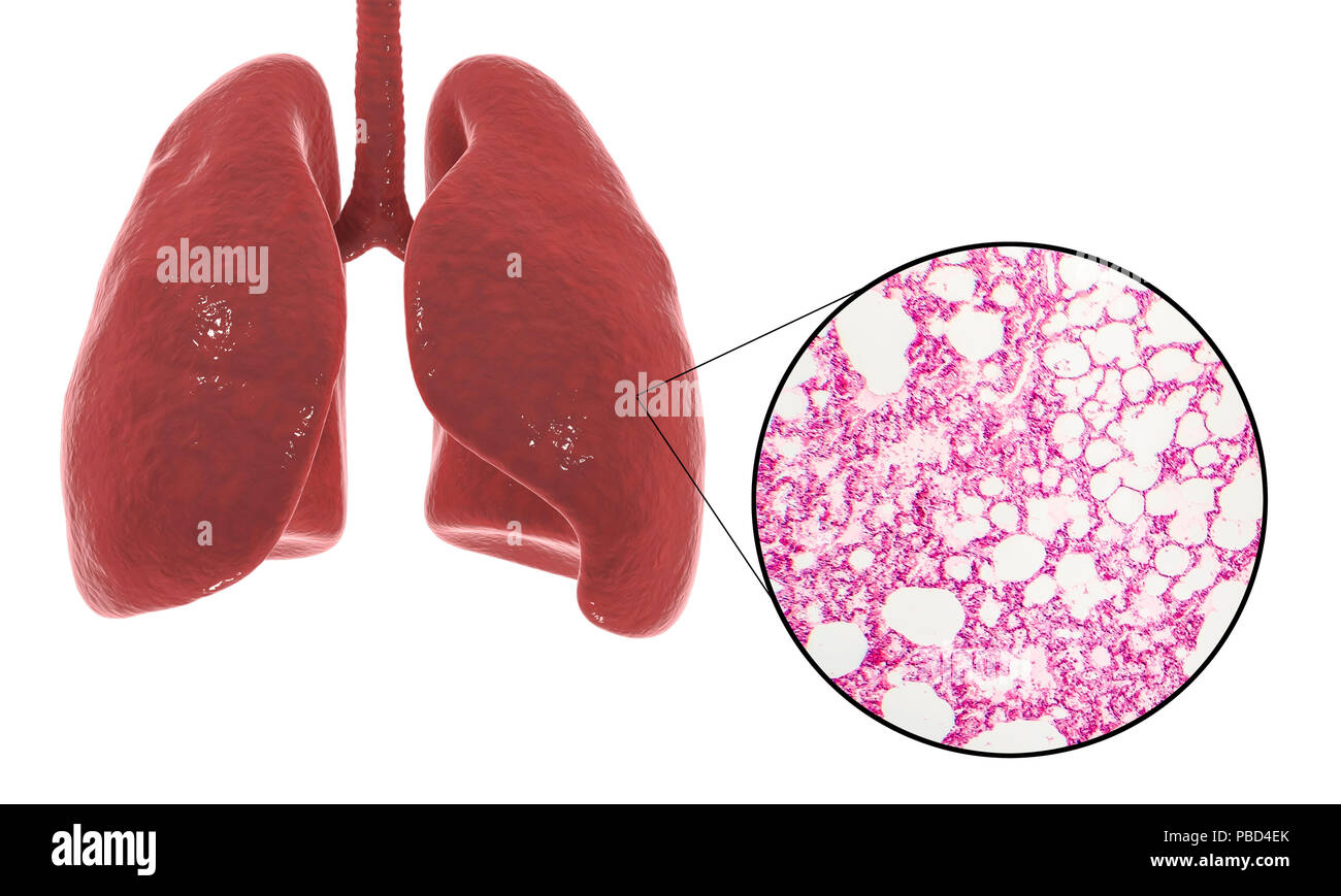 Computer illustration showing human lung anatomy and a light micrograph of a section through healthy lung tissue showing alveoli (air sacs, white). The alveoli are the site of gaseous exchange, where oxygen enters the blood and carbon dioxide is removed. Stock Photo