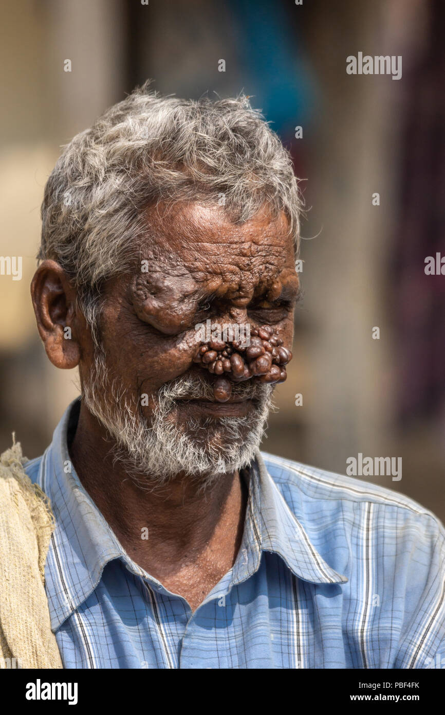 Belathur, Karnataka, India - November 1, 2013: Closeup of man with neurofibromatosis has face deformed with group of dark brown tumors on his nose. Bl Stock Photo