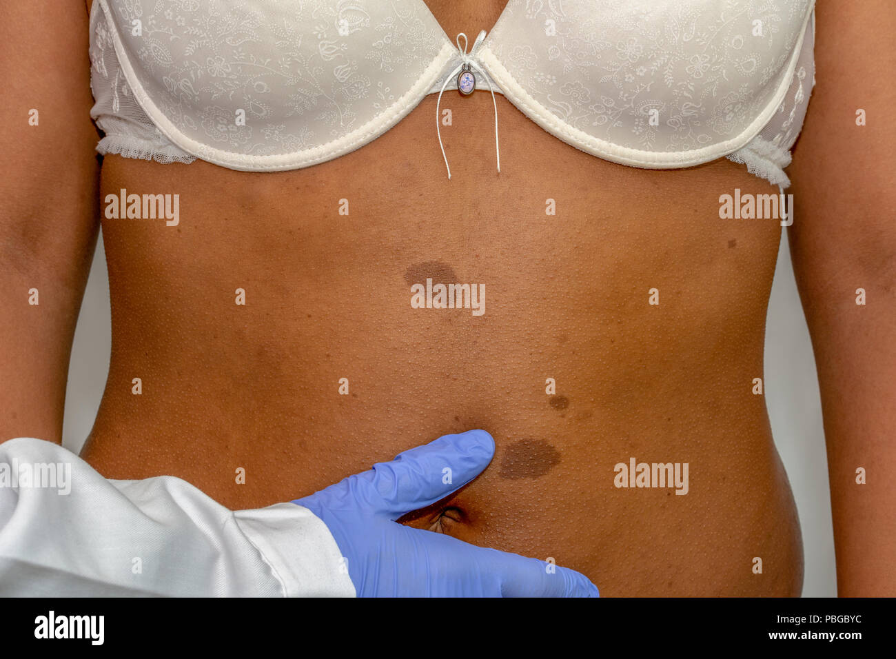 Young african woman with birthmark on her back skin. Checking benign moles Stock Photo