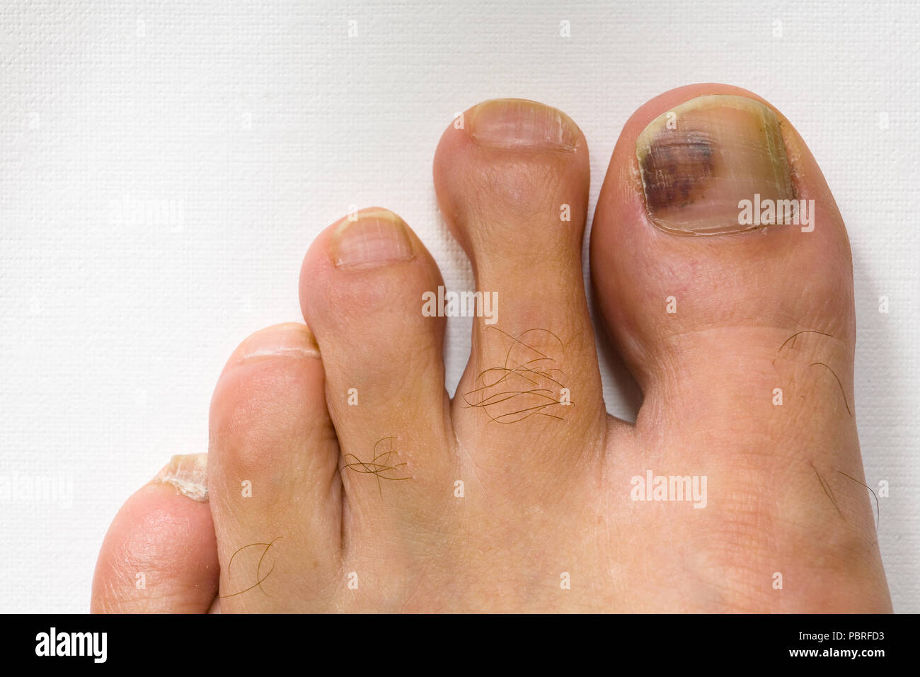 The bruised finger of the male foot close-up. Part of the body. Stock Photo
