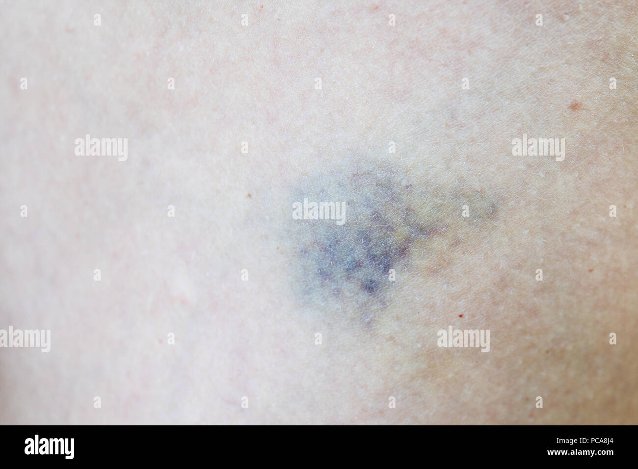 Close up on a fresh bruise on the skin Stock Photo Alamy