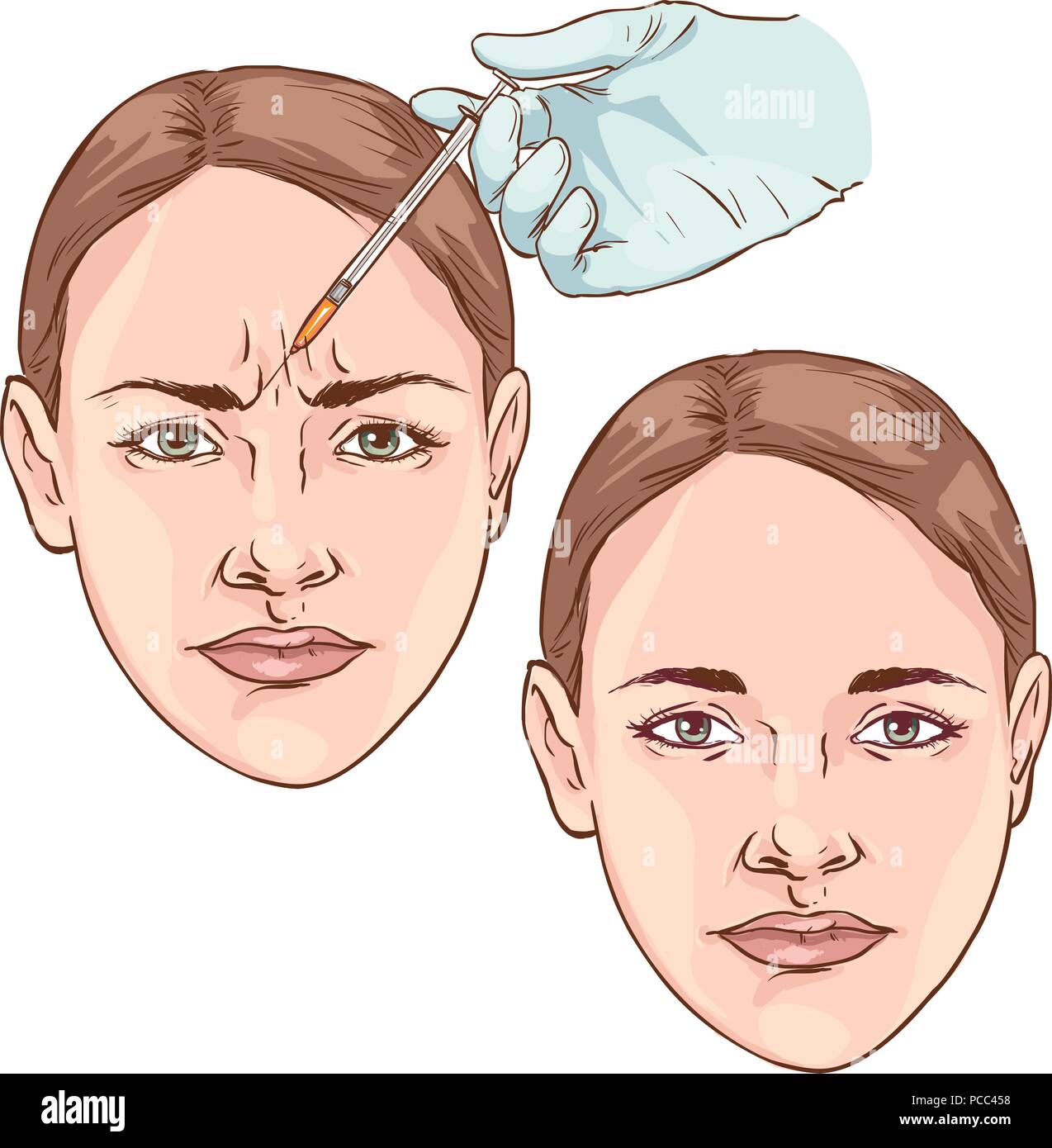 Wrinkles on the forehead. rejuvenation. plastic surgery Stock Vector