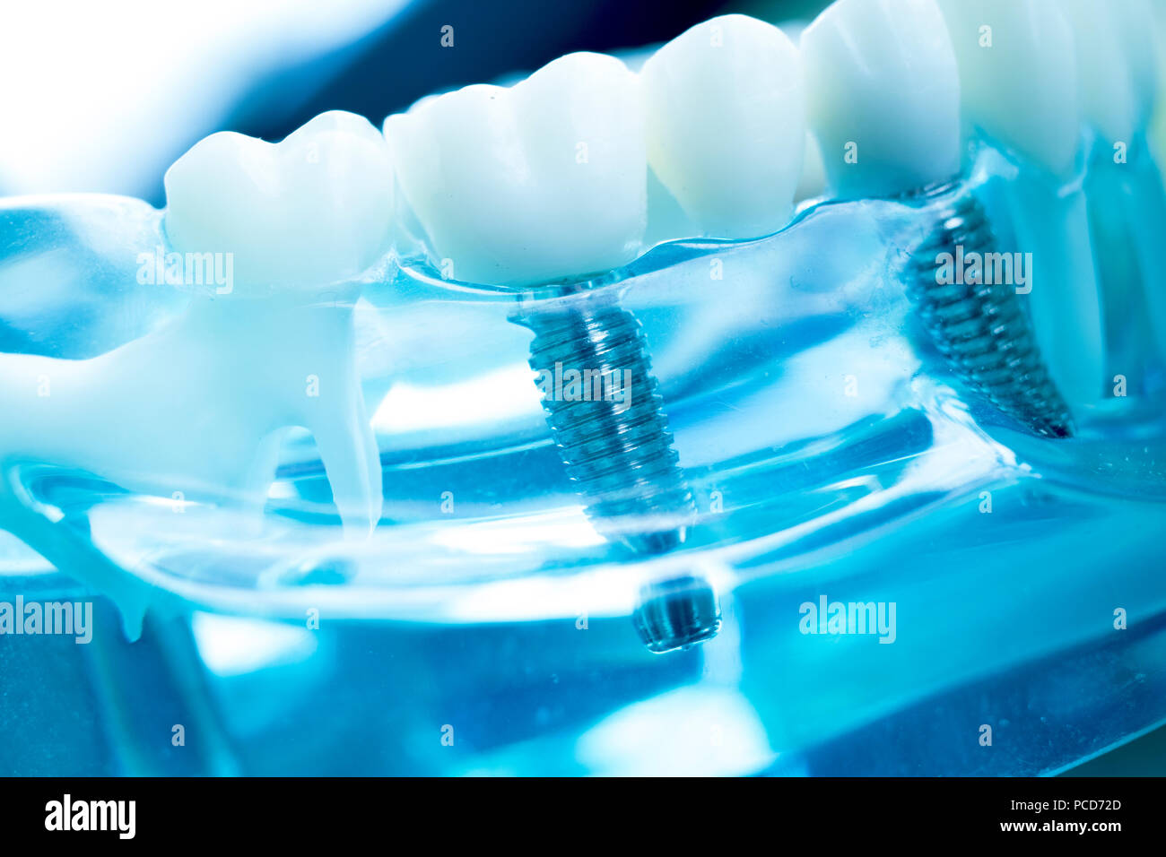 Dentist dental teeth teaching model showing titanium metal tooth