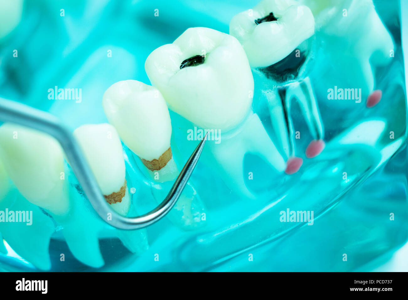 Dentist cleaning teeth with titanium metal tooth pick instrument to