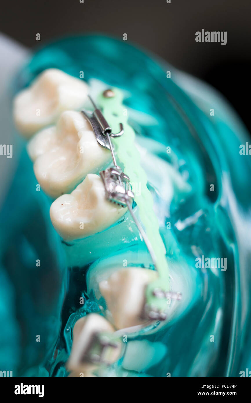 Dental metal braces teeth retainer aligners teaching orthodontics model