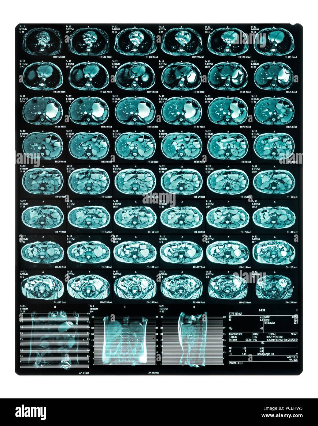 MRI Scan. MR Enterography of the small intestine a noninvasive medical test used to diagnose medical conditions of the bowels, like Crohn's disease Stock Photo