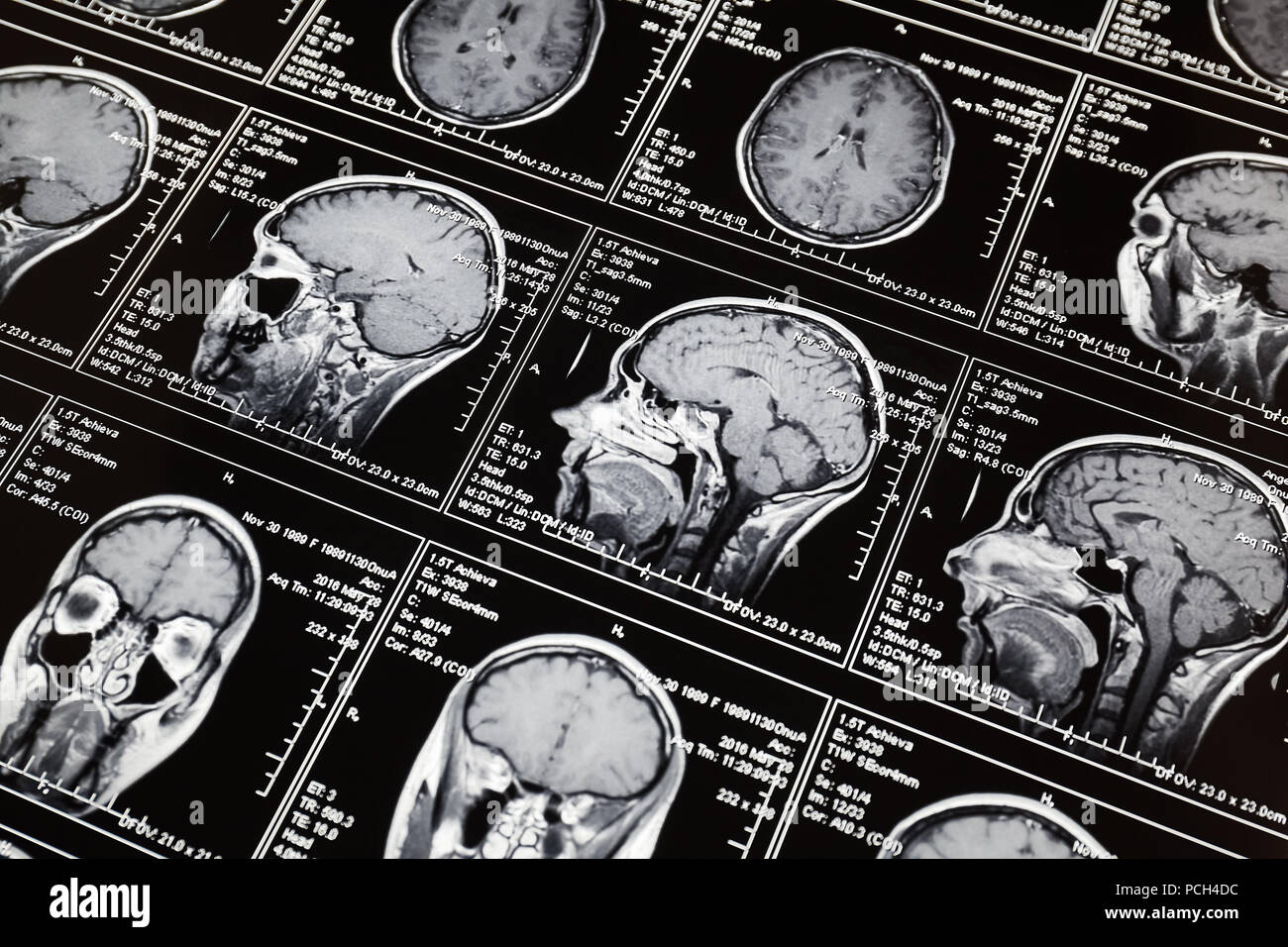 Magnetic resonance scan of the brain. MRI head scan Stock Photo - Alamy