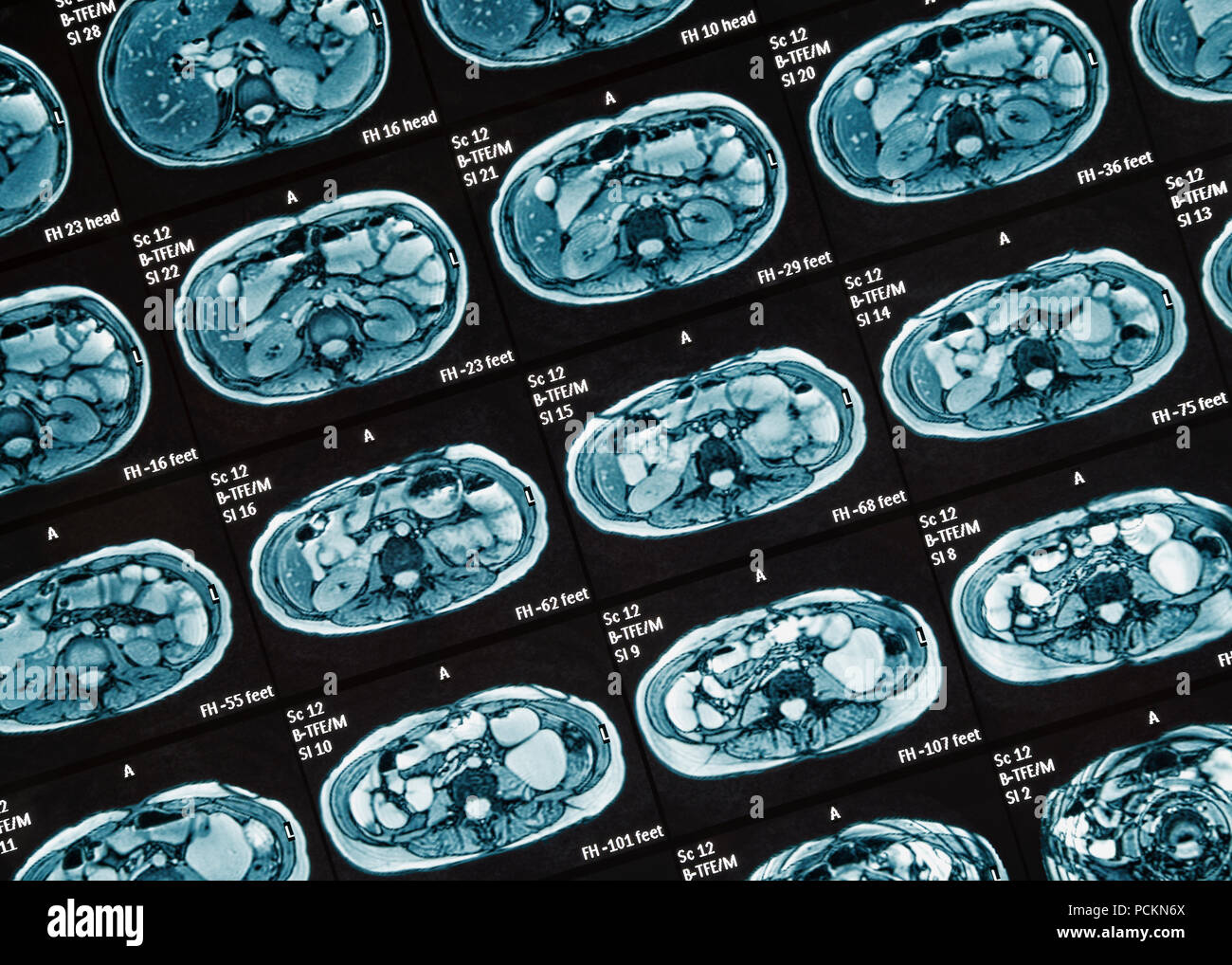 MRI Scan, Close Up. MR Enterography of the small intestine a noninvasive medical test used to diagnose medical conditions of the bowels, like Crohn's  Stock Photo