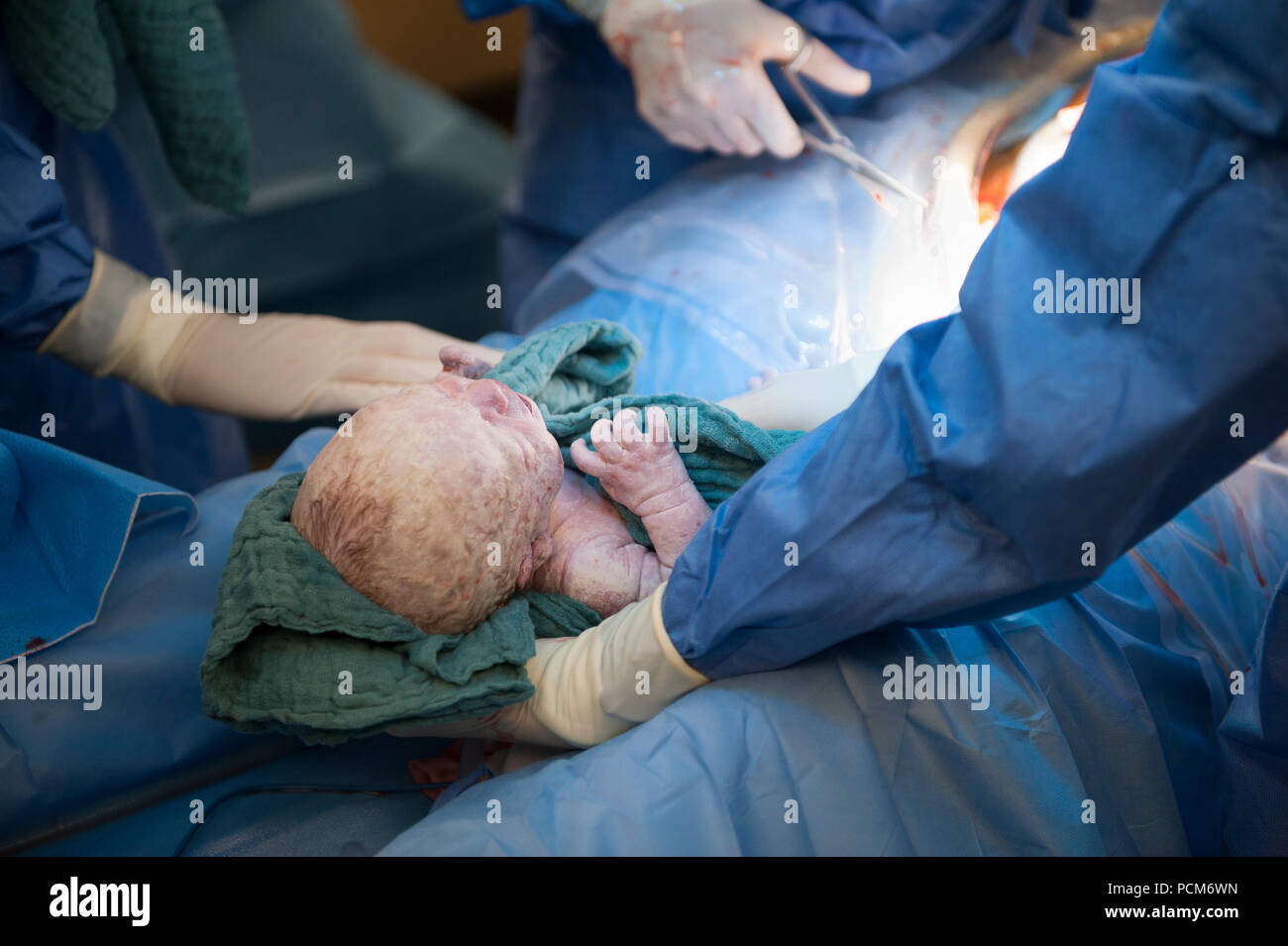 A woman giving birth to twins by caesarean section (Heverlee, 30/12/2016) Stock Photo