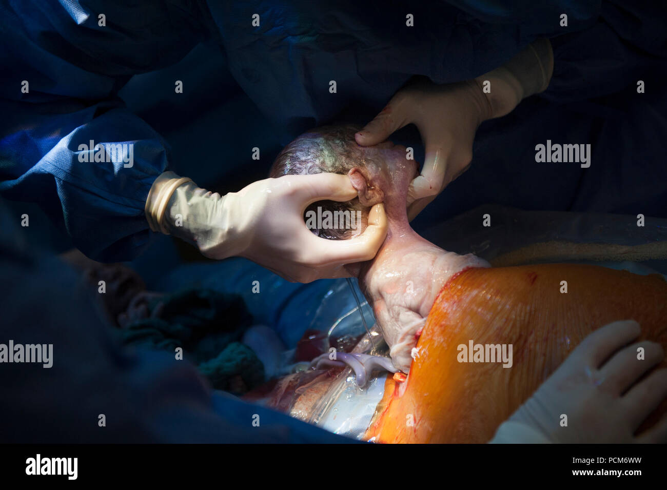 A woman giving birth to twins by caesarean section (Heverlee, 30/12/2016) Stock Photo