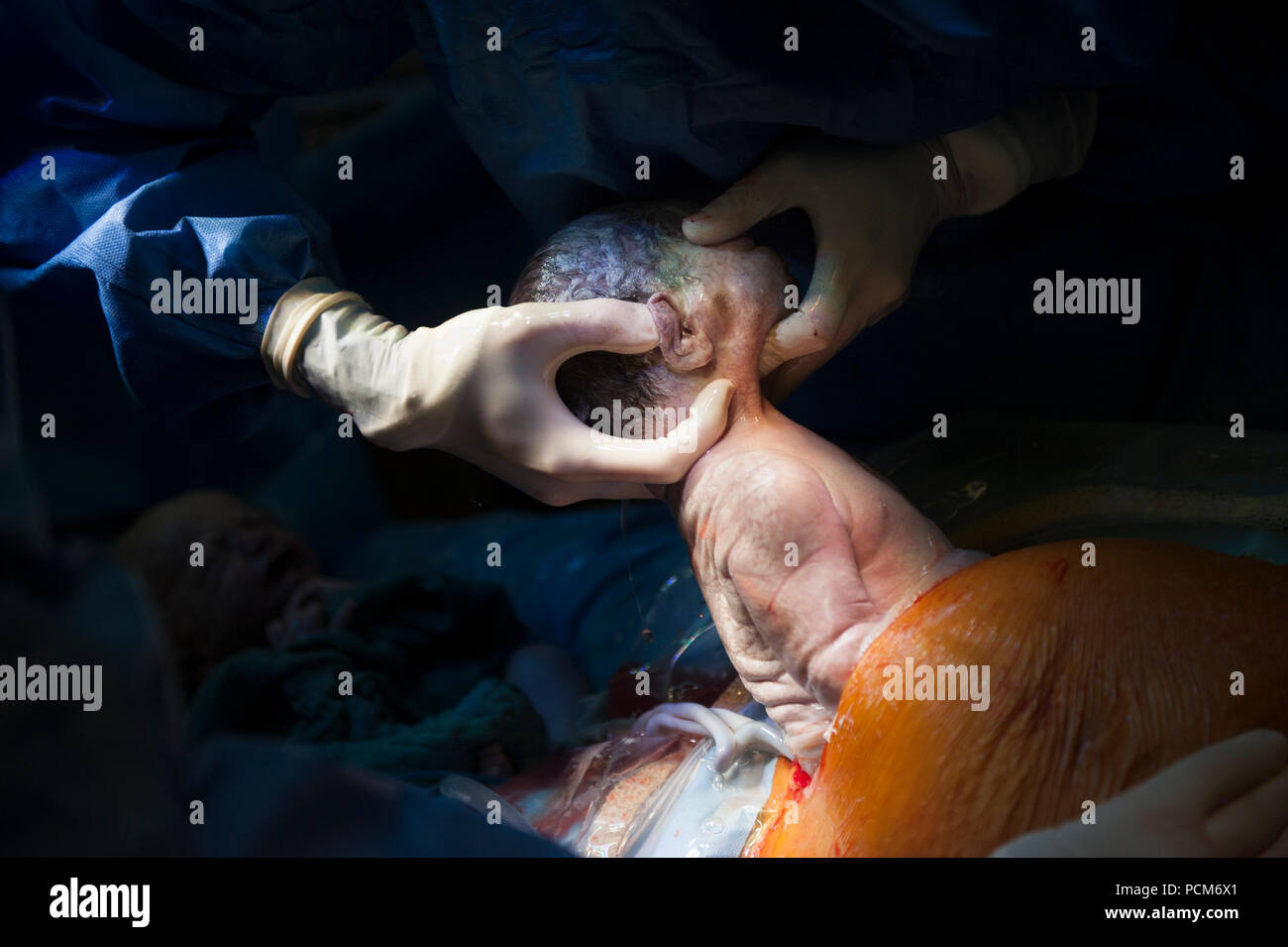 A woman giving birth to twins by caesarean section (Heverlee, 30/12/2016) Stock Photo