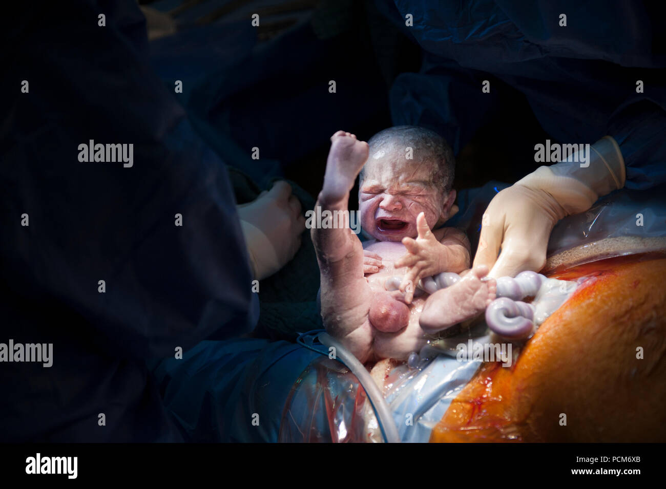 A Woman Giving Birth To Twins By Caesarean Section Heverlee 30 12 16 Stock Photo Alamy