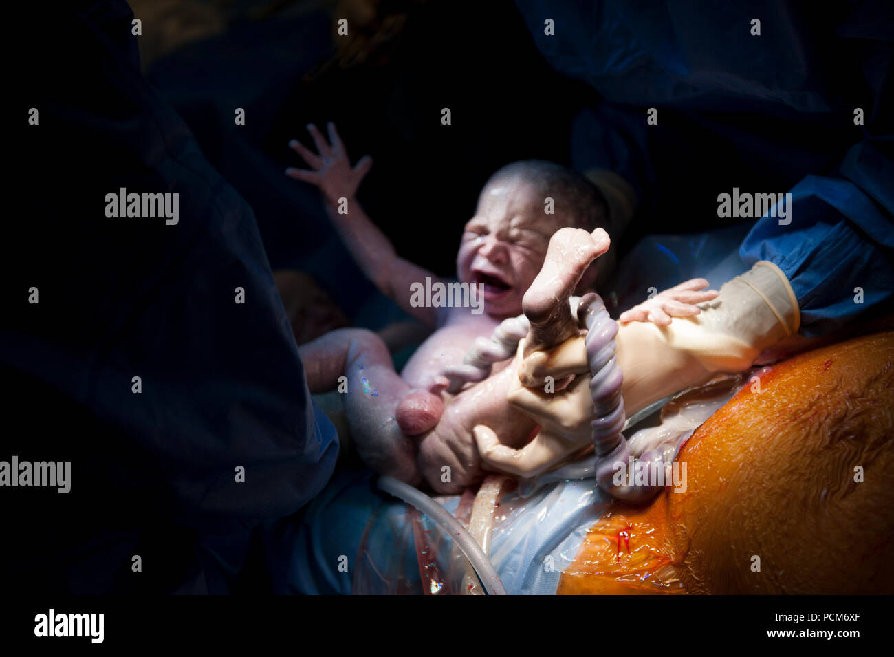 A Woman Giving Birth To Twins By Caesarean Section Heverlee 30 12 16 Stock Photo Alamy