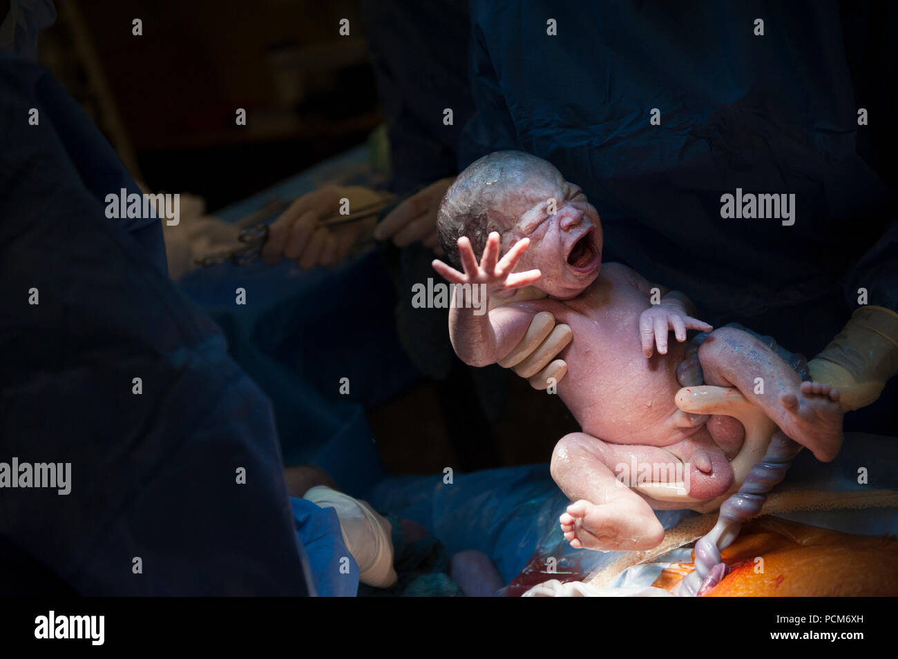 A Woman Giving Birth To Twins By Caesarean Section Heverlee 30 12 16 Stock Photo Alamy