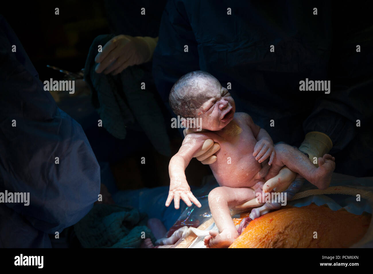 A Woman Giving Birth To Twins By Caesarean Section Heverlee 30 12 16 Stock Photo Alamy