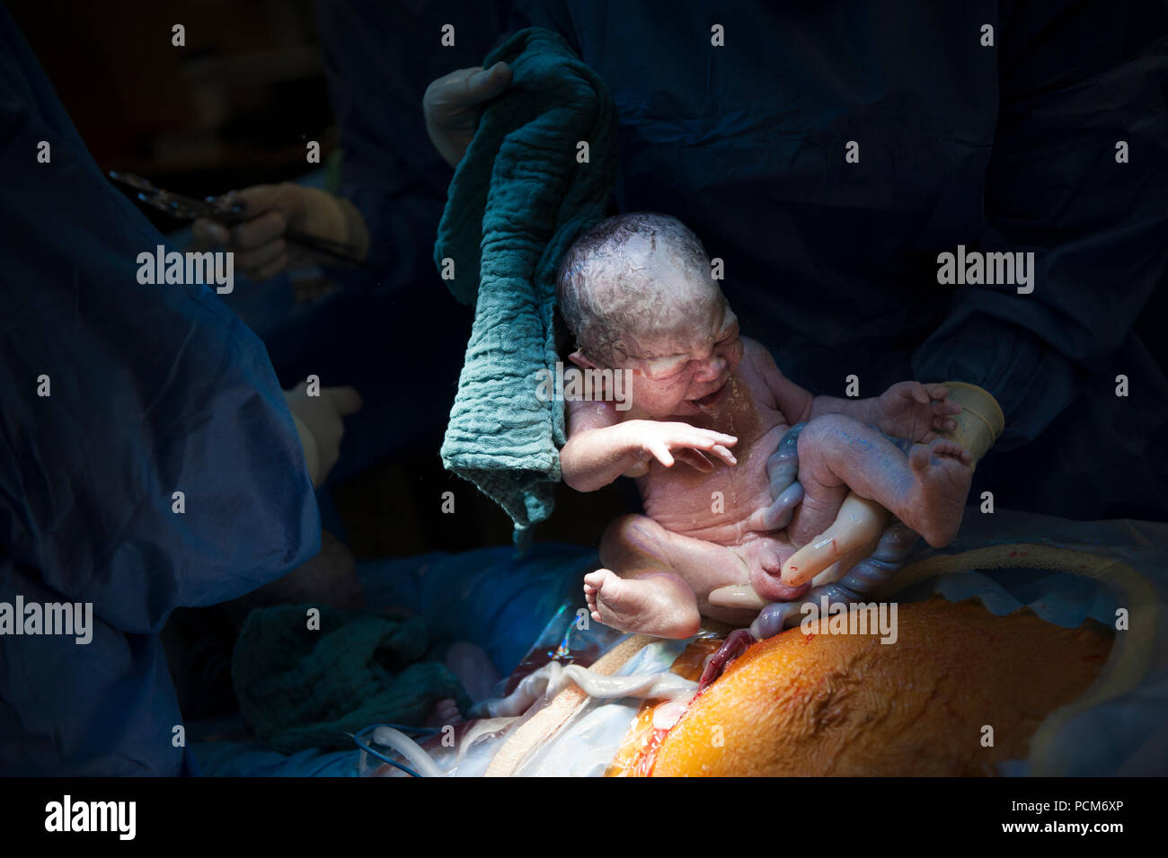 A Woman Giving Birth To Twins By Caesarean Section Heverlee 30 12 16 Stock Photo Alamy