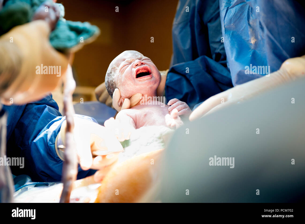 A woman giving birth to twins by caesarean section (Heverlee, 30/12/2016) Stock Photo