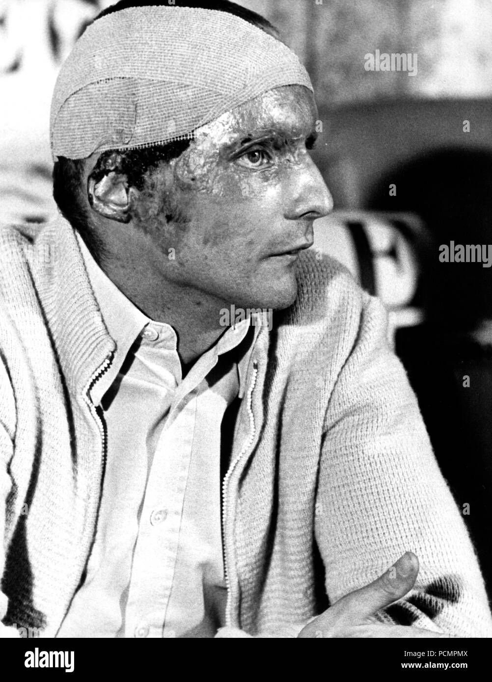 The Austrian Formula 1 driver Niki Lauda with scarred face, head bandage  and burns during a press conference in Salzburg on September 8, 1976. Lauda,  who had suffered the serious injuries in