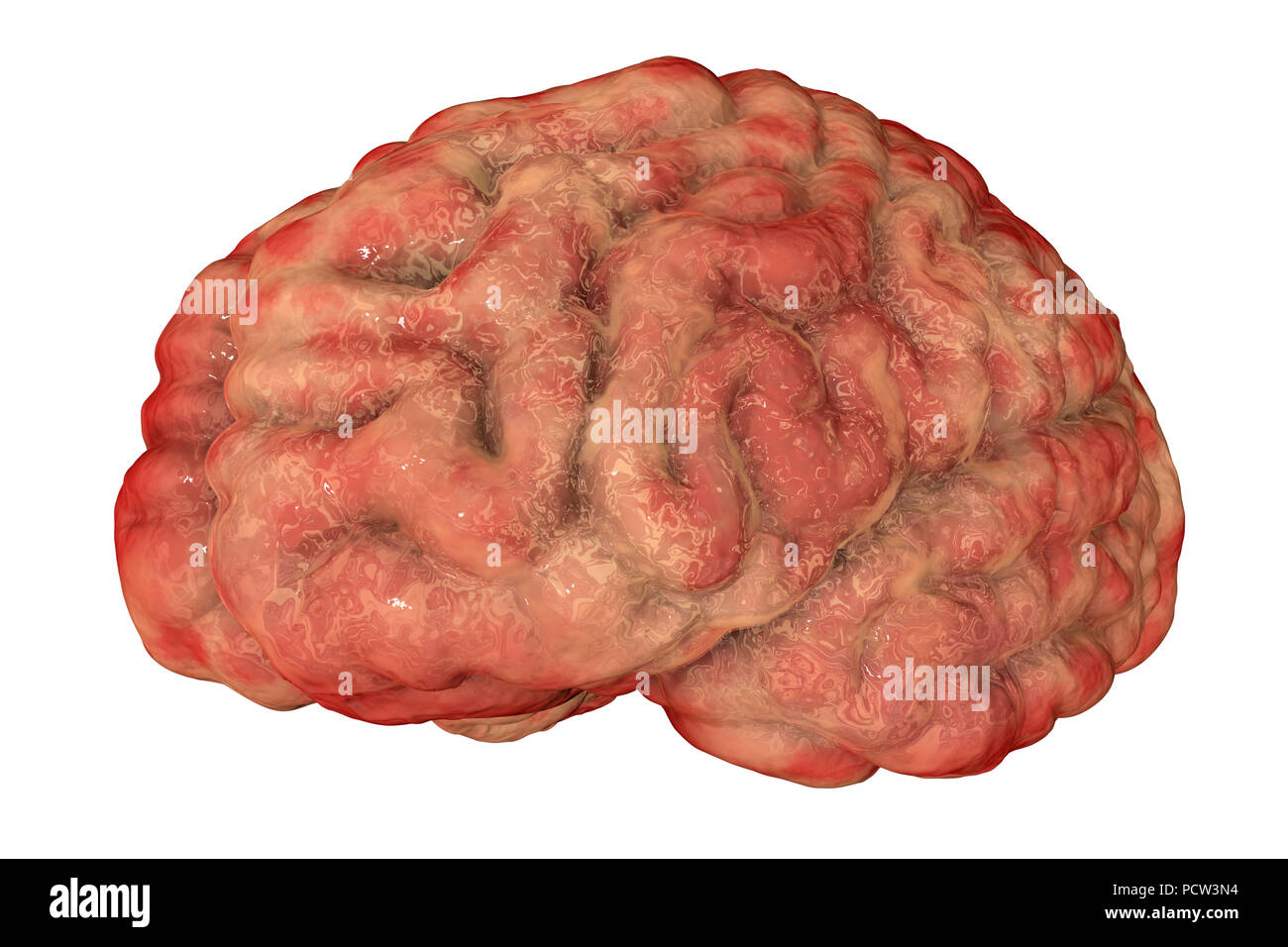 Brain with encephalitis. Computer illustration showing brain with signs of encephalitis, such as brain edema, haemorrhages and necrosis. Stock Photo
