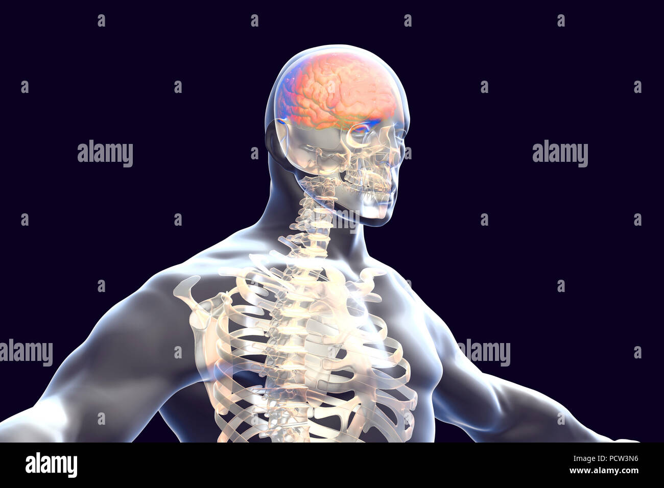 Brain with encephalitis. Computer illustration showing brain with signs