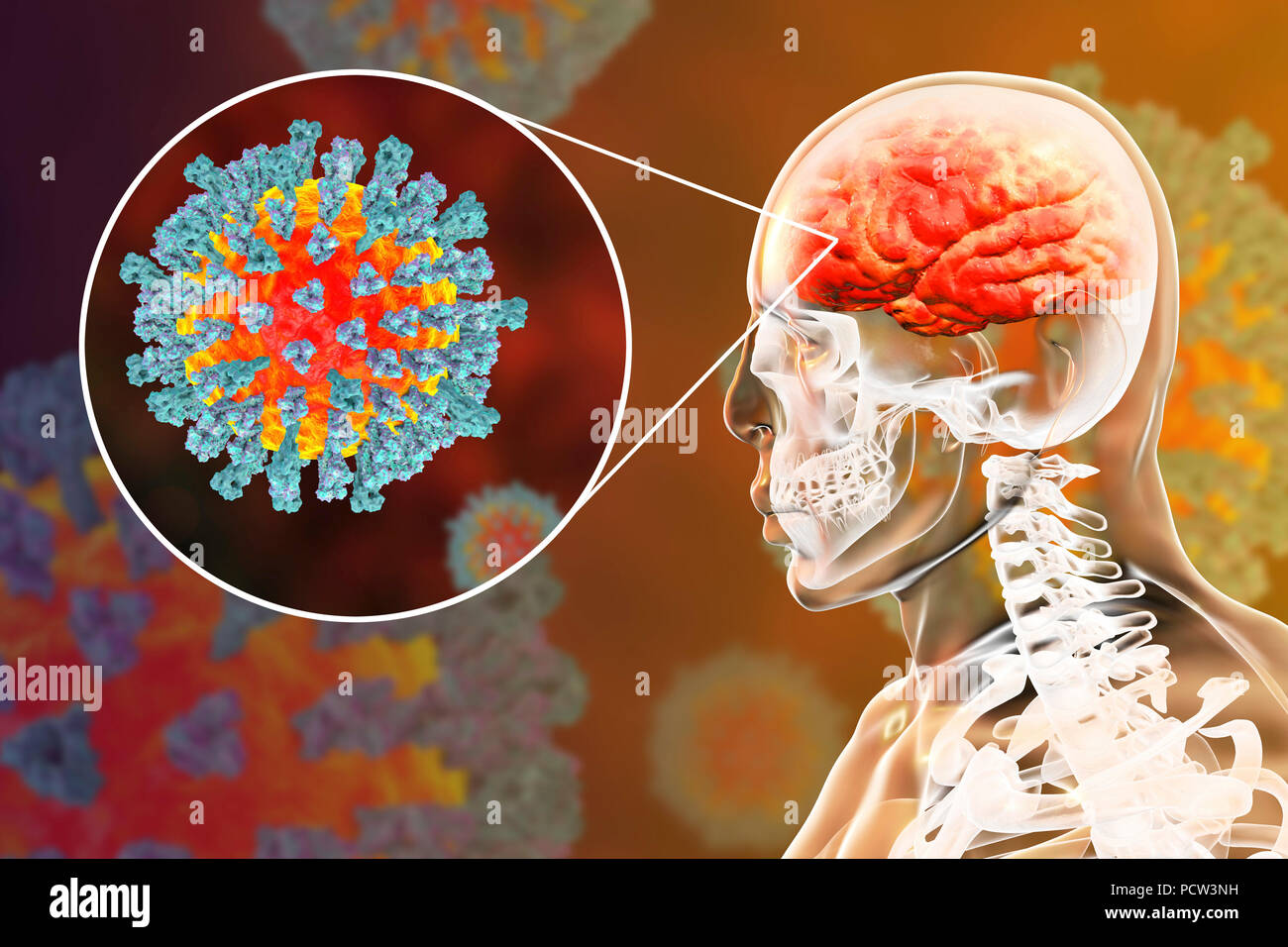 Encephalitis caused by measles viruses, computer illustration. This virus, from the Morbillivirus group of viruses, consists of an RNA (ribonucleic acid) core surrounded by an envelope studded with surface proteins haemagglutinin-neuraminidase and fusion protein, which are used to attach to and penetrate a host cell. Measles is a highly infectious itchy rash with a fever. It mainly affects children and one attack usually gives life-long immunity. Encephalitis is one of complications of measles infection. Stock Photo