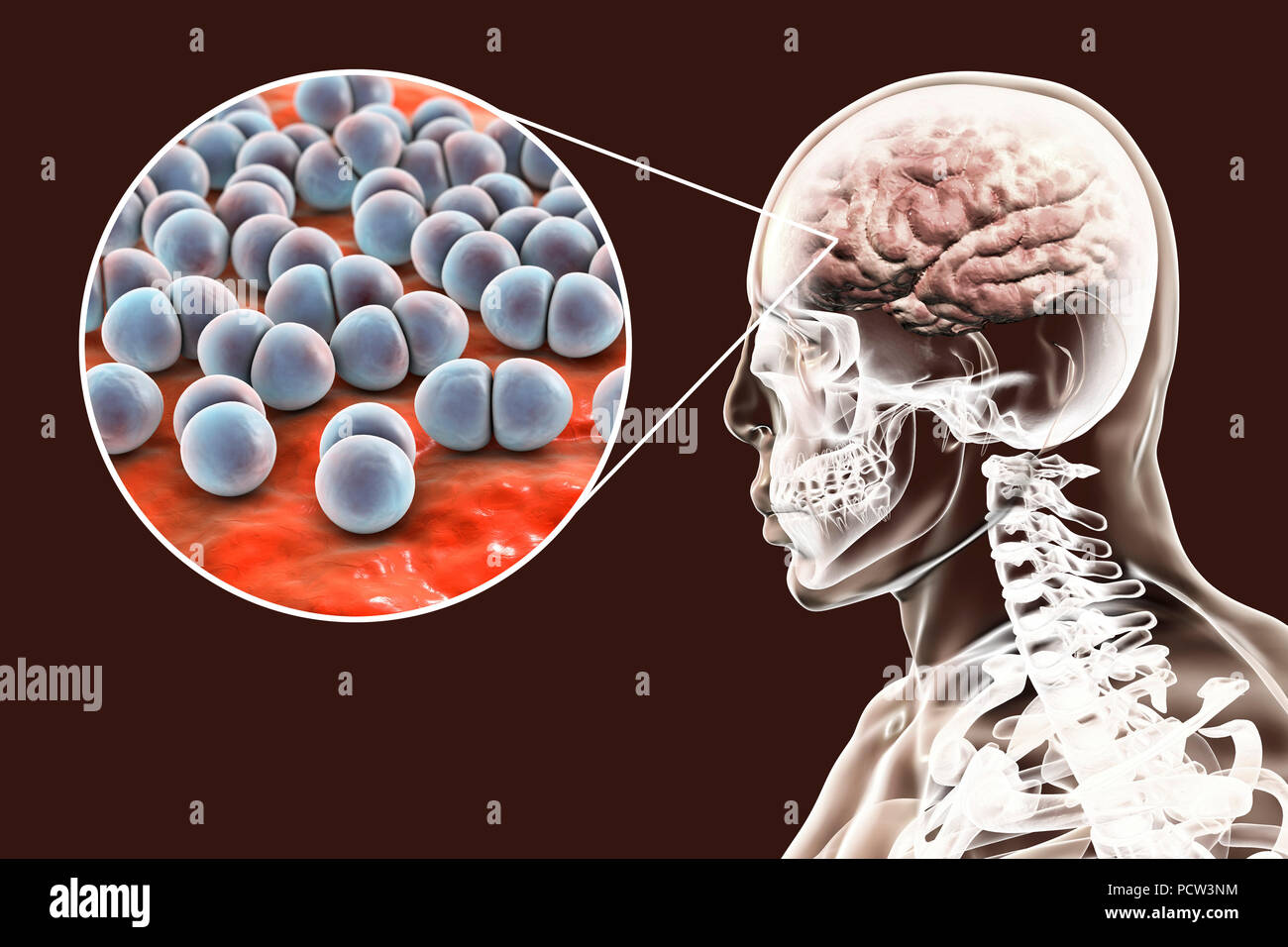 Brain infection caused by Streptococcus pneumoniae bacteria, computer illustration. S. pneumoniae are Gram-positive bacteria arranged in pairs (diplococci), they are common causative agents of infections of different location, including bacterial meningitis, meningoencephalitis and encephalitis. Stock Photo