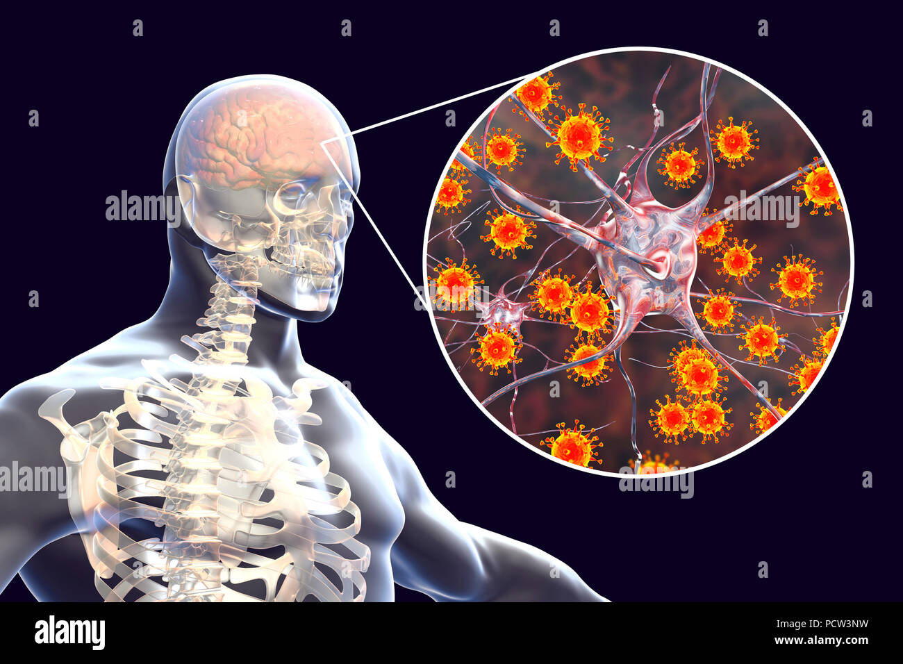 Viral encephalitis. Conceptual illustration showing brain with signs of ...