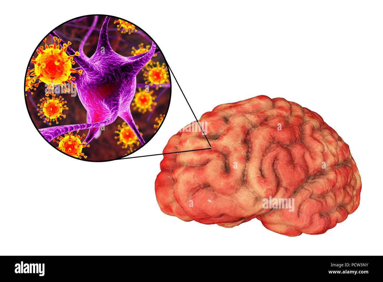 Воспалительные процессы в головном мозге. Риногенный гнойный менингит. Энцефалит воспаление головного мозга. Серозный вирусный менингит. Воспалительные поражения головного мозга.