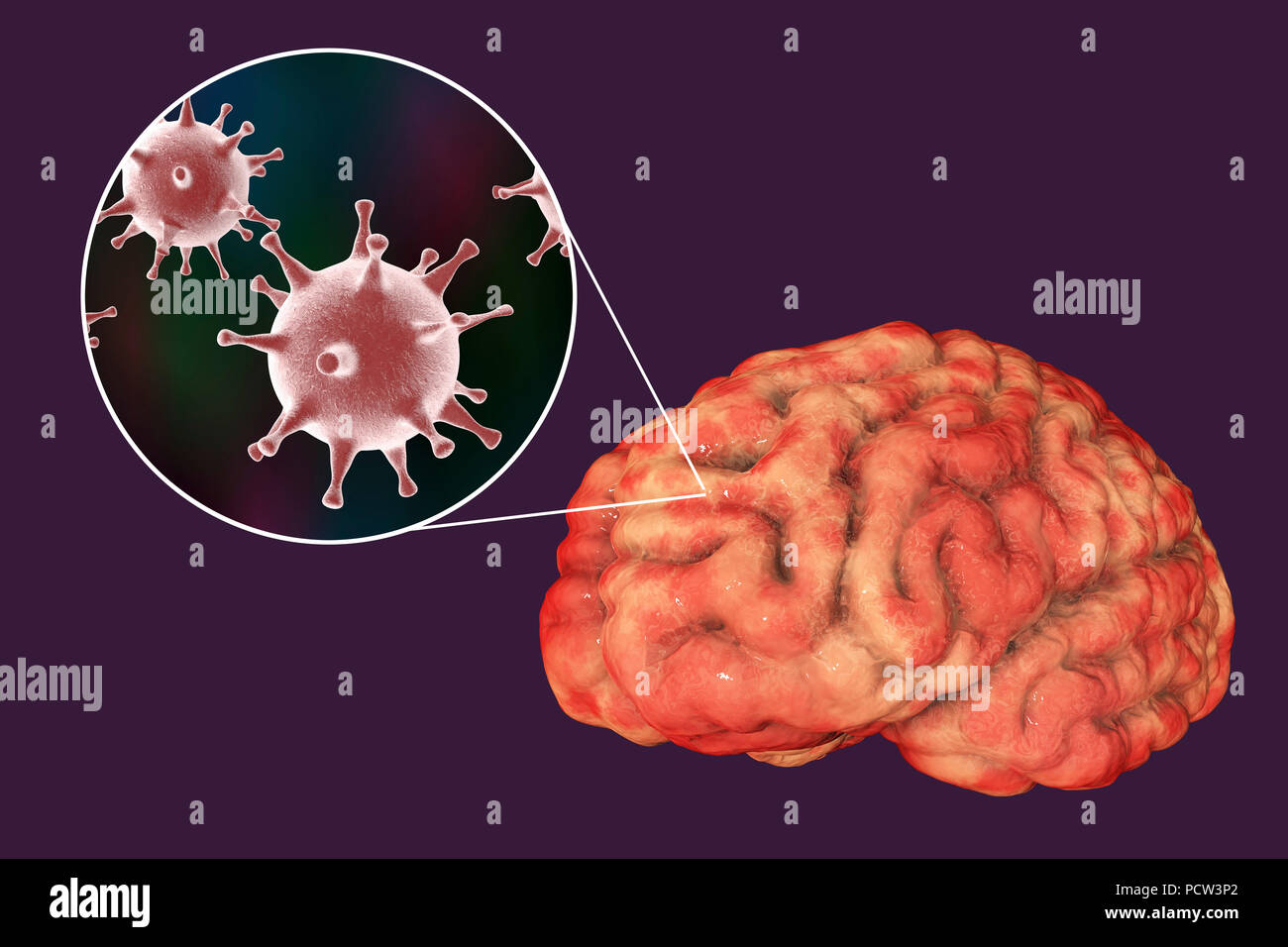 Brain infection caused by Herpes viruses, computer illustration. Stock Photo