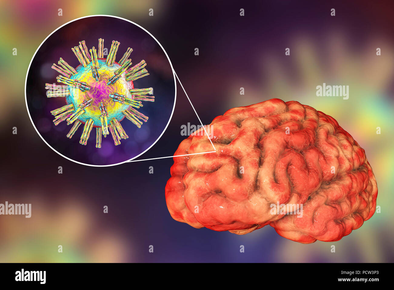 Brain infection caused by Herpes viruses, computer illustration. Stock Photo