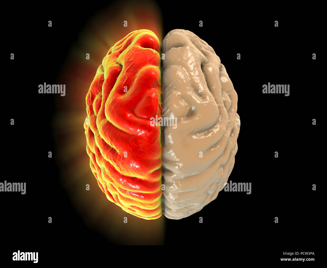 Migraine, conceptual computer illustration. Stock Photo