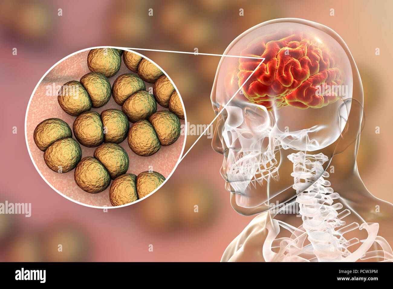Neisseria meningitidis brain infection, computer illustration. N