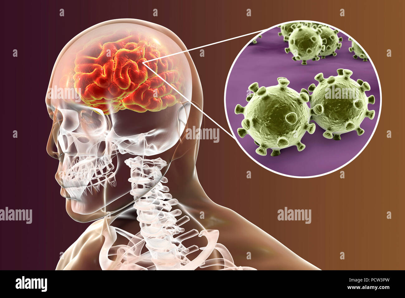Viral encephalitis. Conceptual illustration showing brain with signs of encephalitis inside human body and close-up view of viruses. Stock Photo