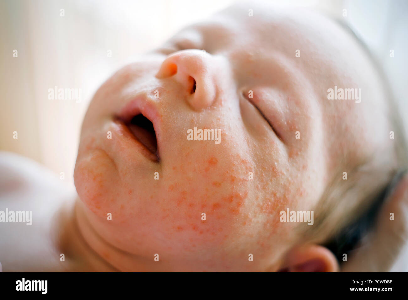Newborn baby boy face with many red pimples caused by atopic dermatitis Stock Photo