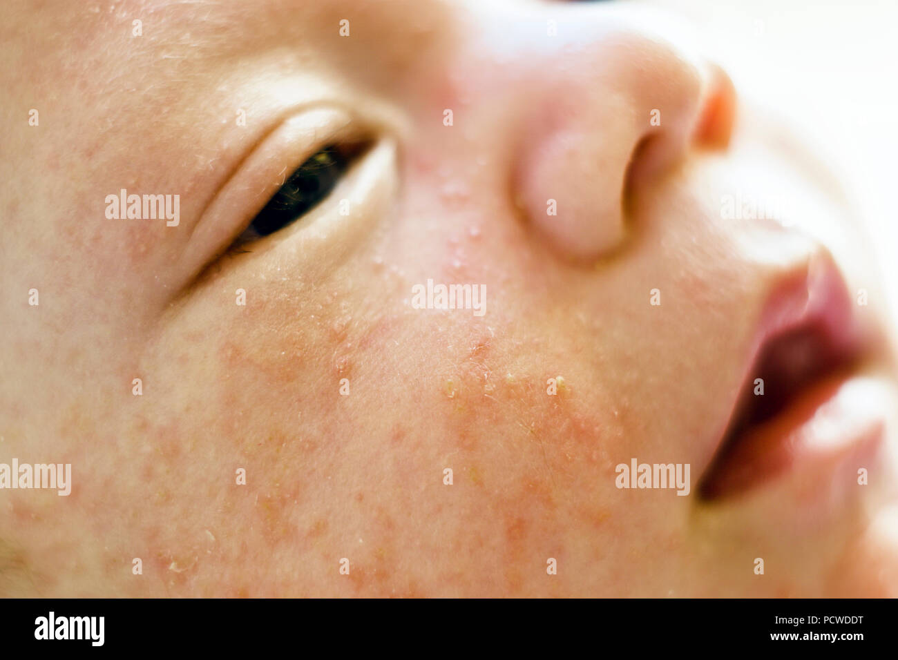 Newborn baby boy face with many pimples caused by atopic dermatitis Stock Photo
