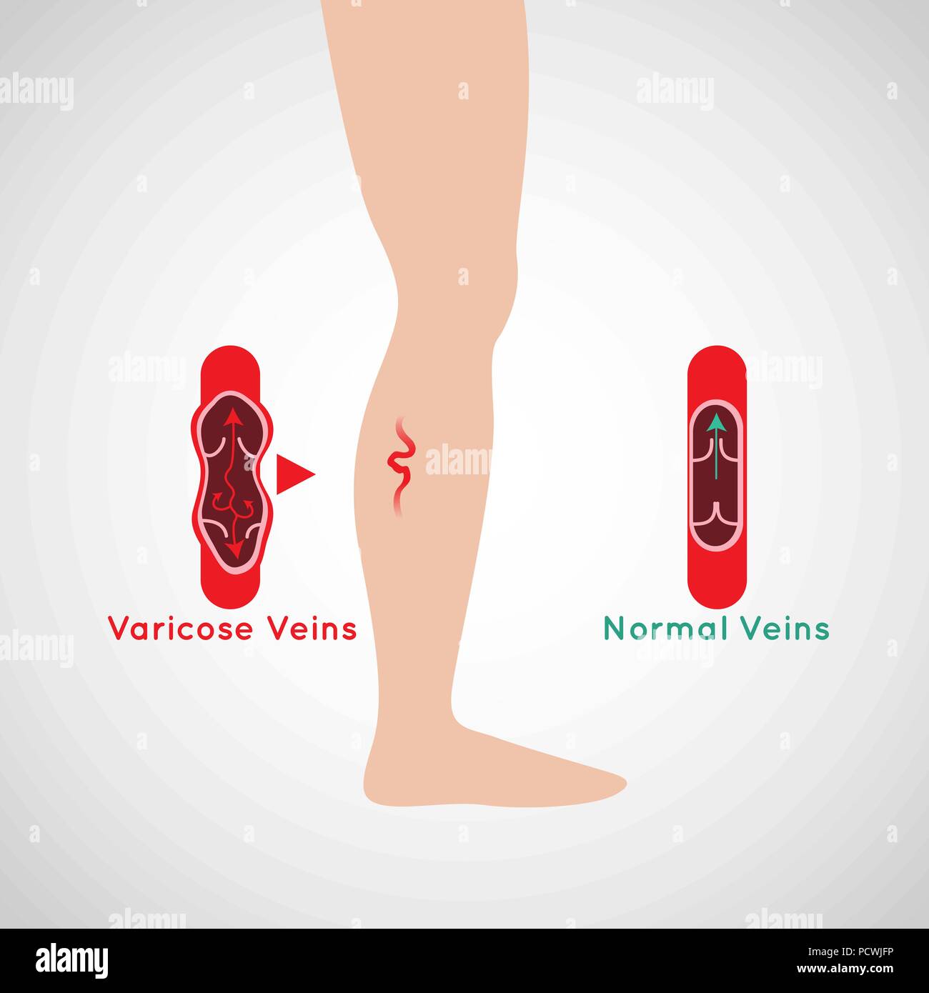 Varicose Veins vector logo icon illustration Stock Vector Image & Art ...