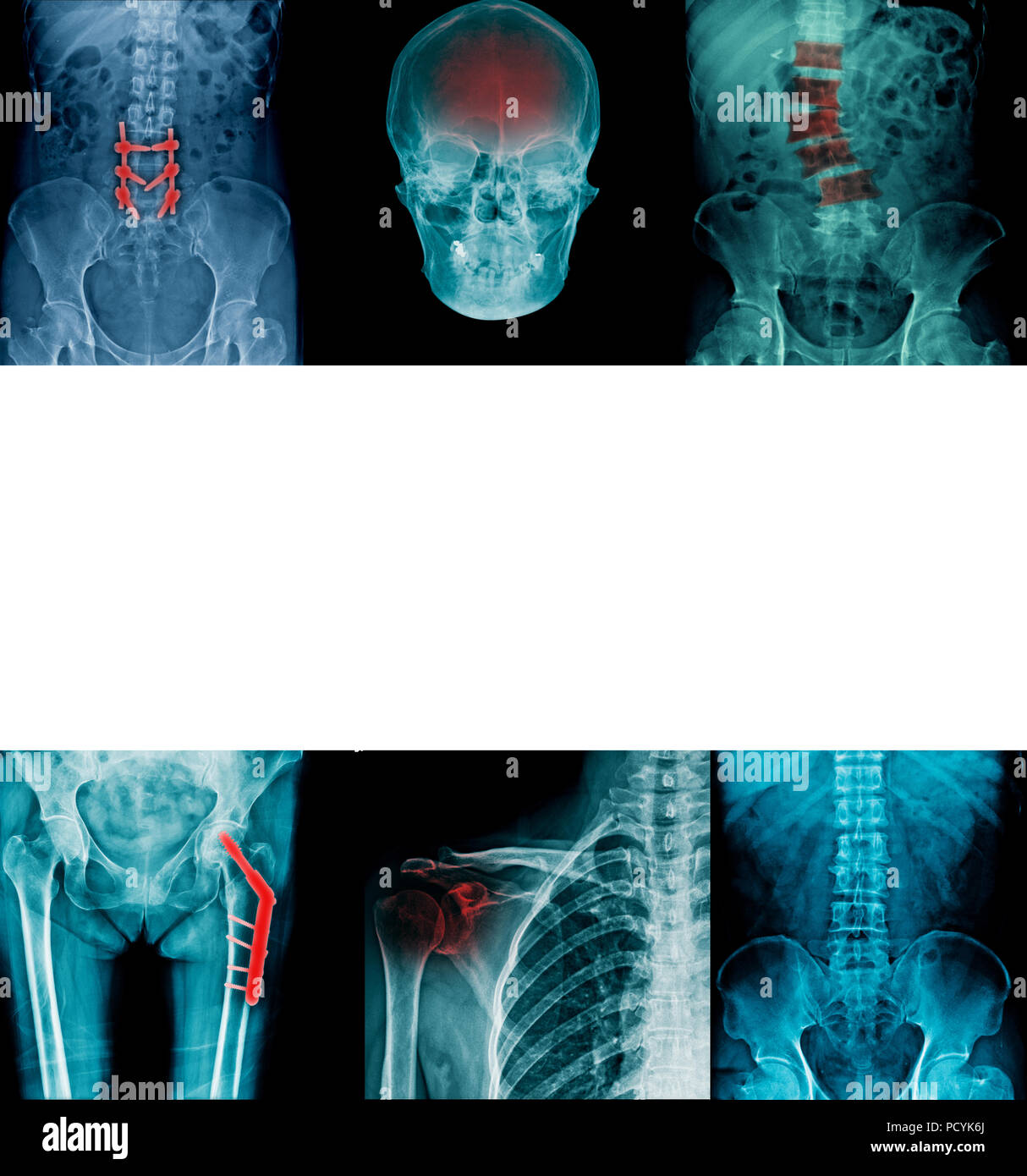 Arthritis Hip X Ray Stock Photos Arthritis Hip X Ray Stock Images Alamy Arthritis Hip X Ray Stock Photos Arthritis Hip X Ray Stock Images Alamy