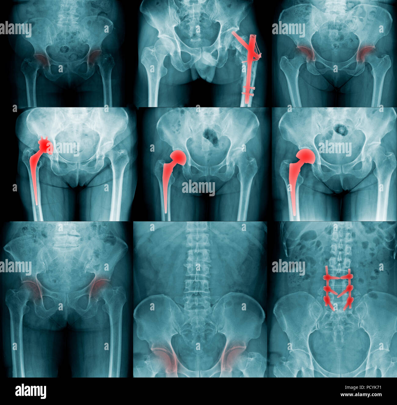 x-ray image, collection hip replacement Stock Photo