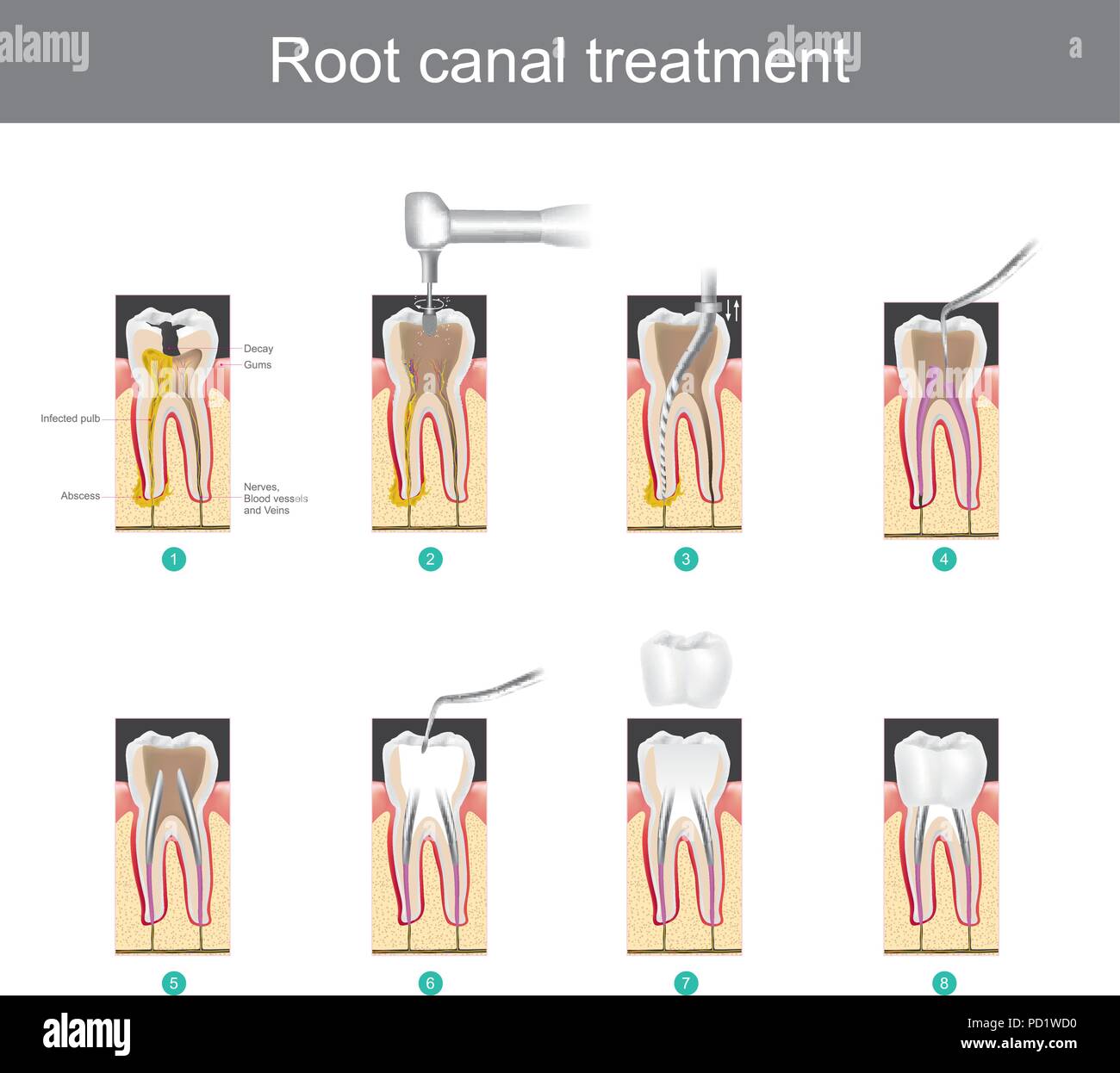Root canal treatment. How to treat our teeth after the tooth is damaged. or severe caries as causes infection or inflammation Stock Vector